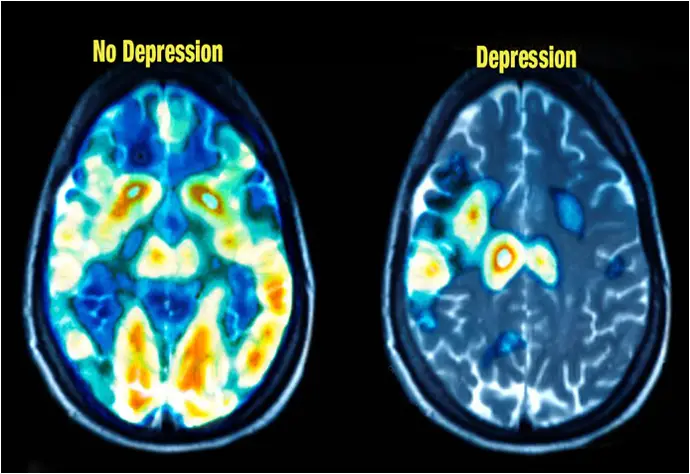 pet scans of healthy and depressed brain. 