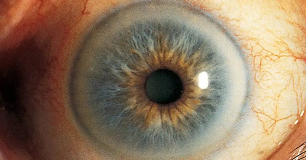 gray ring around cornea