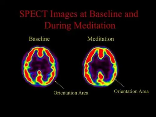 brain changes before and after meditation