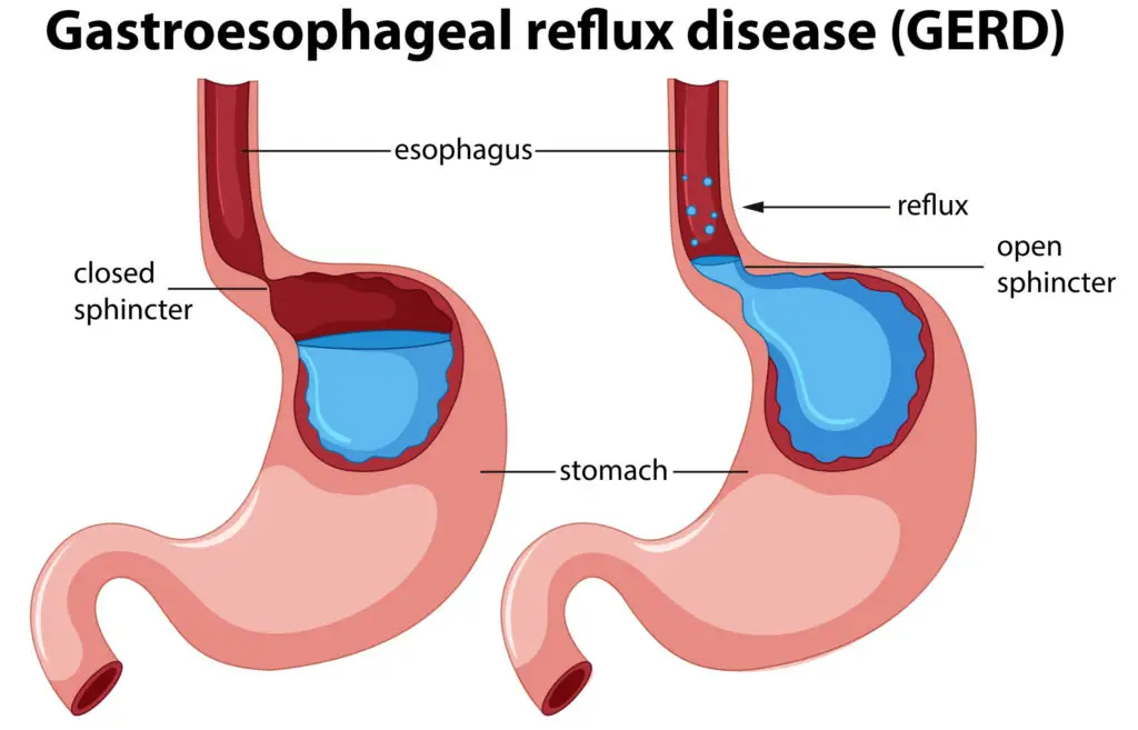 GERD (Gastroesophageal Reflux Disease or Acid Reflux)