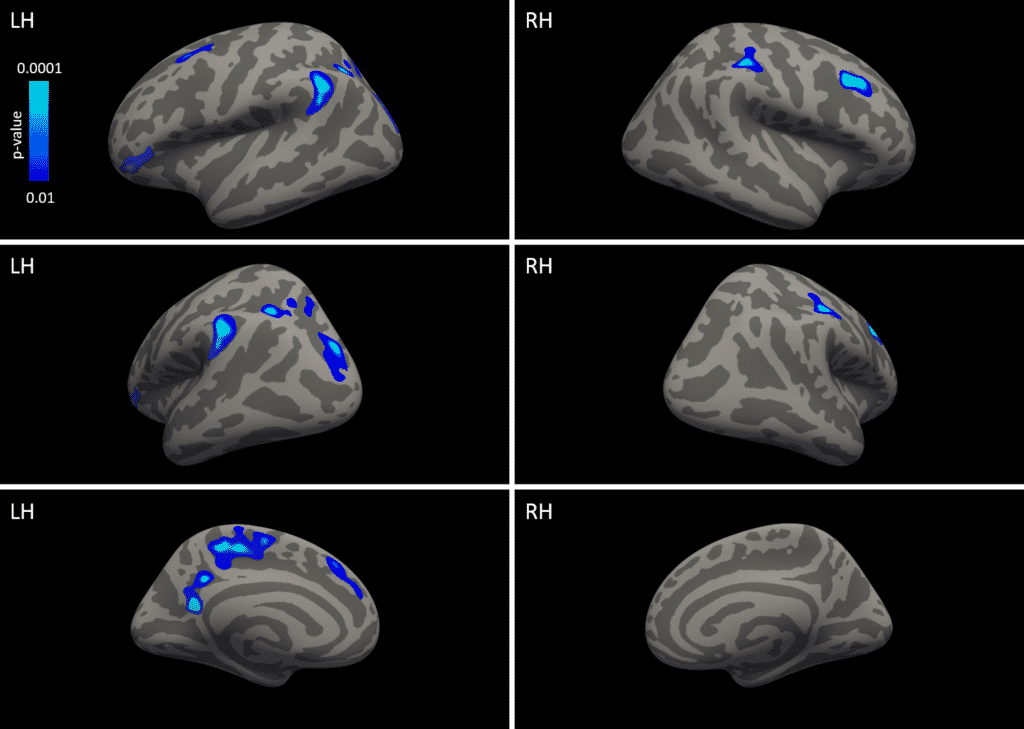 Inflated view of cortical thickness differences in Chinese chess experts