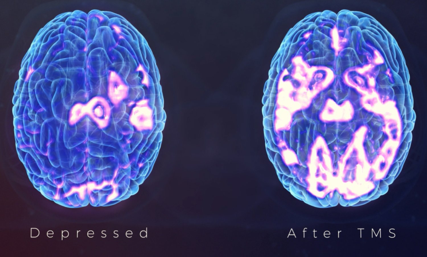 Effect of TMS