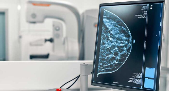 AI can help improve breast cancer risk predictions
