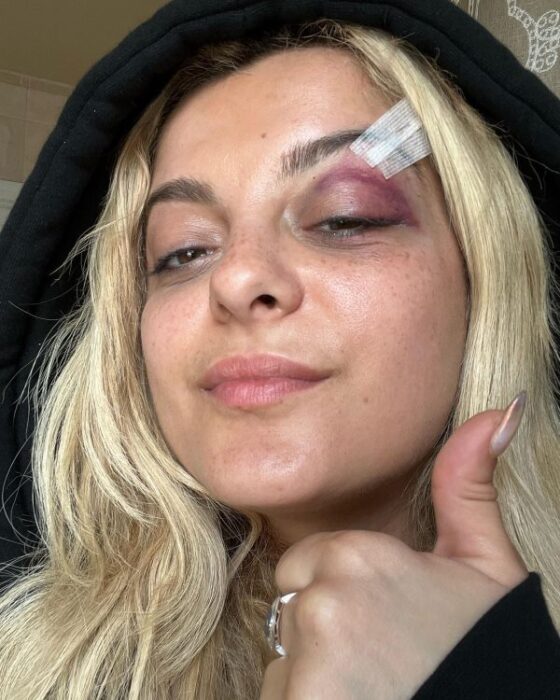 Bebe Rexha Hit With Phone During Concert