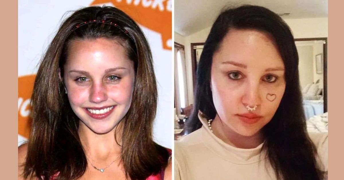 Amanda Bynes Opens Up About Bleph Surgery: A Transformative Journey to Self-Confidence