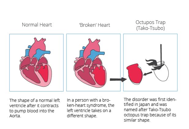 broken heart syndrome