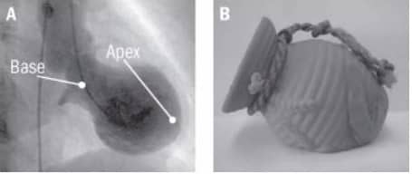 Takotsubo Cardiomyopathy