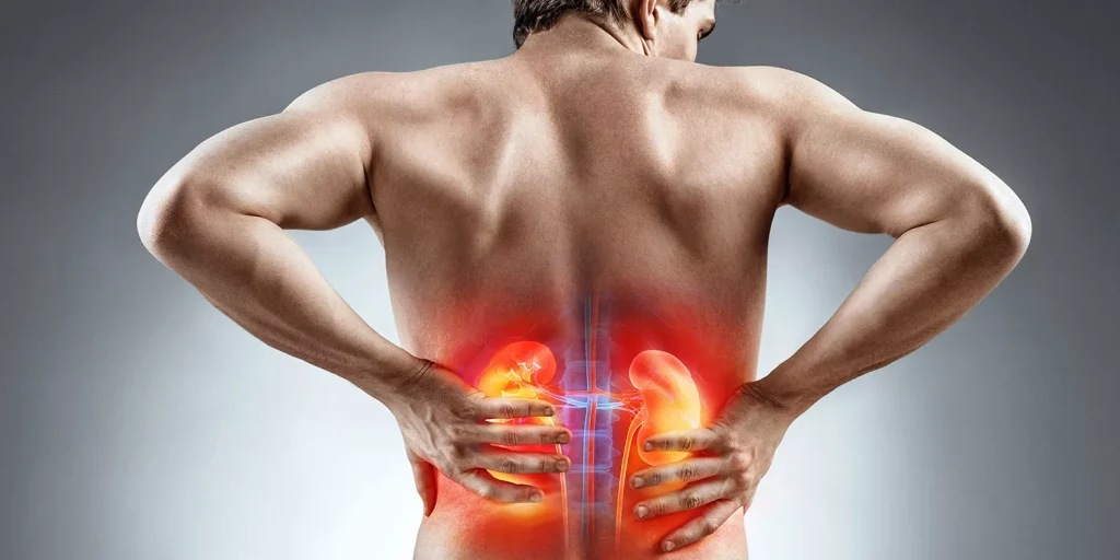 Do Kidney Stones Cause Back Pain