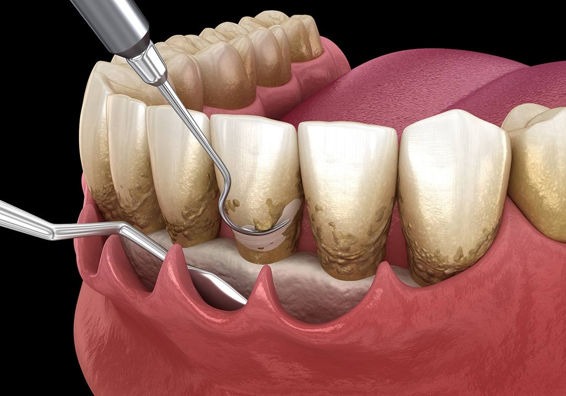 Periodontitis Treatment Near Me: How to Choose the Right Dental Clinic